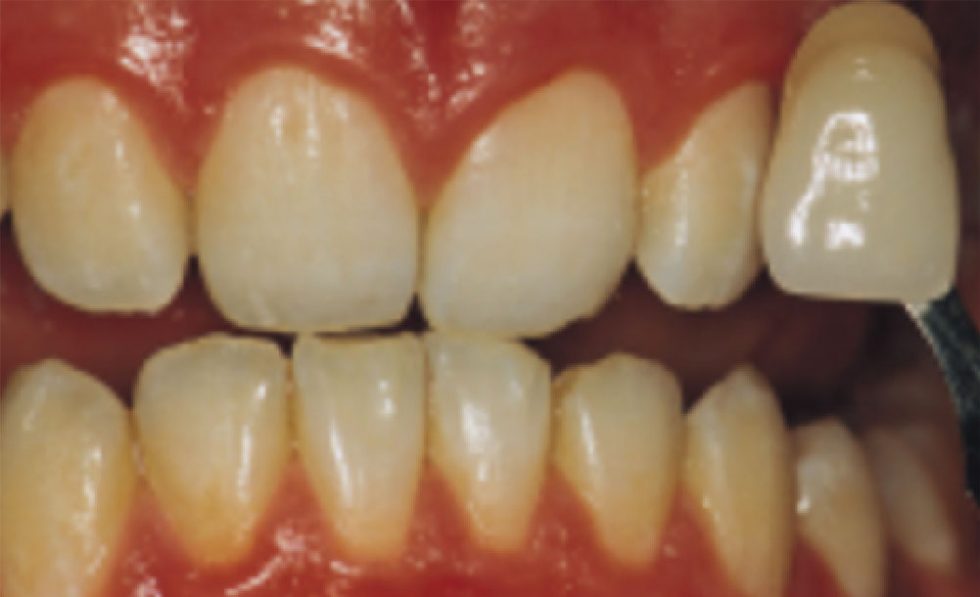 Professional Teeth Whitening in Swindon Dentalcare Swindon